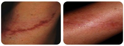 Microneedling (Scar Removal)